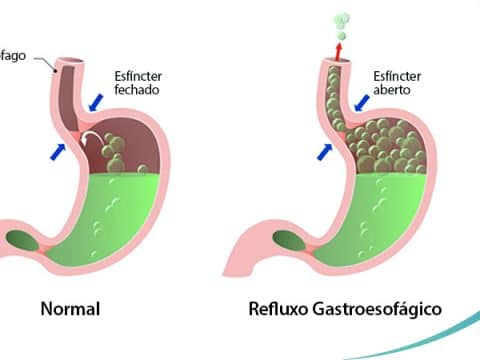 ilustração mostrando refluxo gastroesofágico Dr. Luiz Gustavo Oliveira cirurgião bariátrico