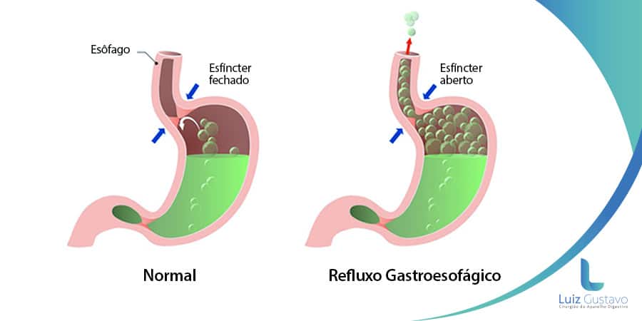 ilustração mostrando refluxo gastroesofágico Dr. Luiz Gustavo Oliveira cirurgião bariátrico