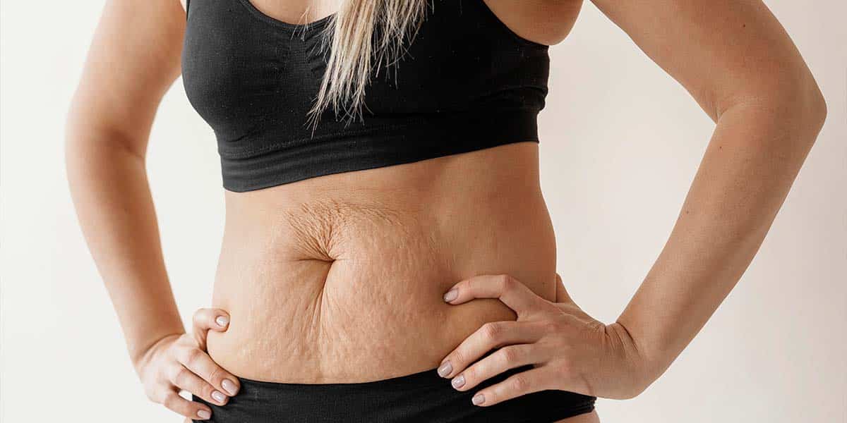 Barriga de mulher com diástase abdominal e flacidez - site Dr. Luiz Gustago Oliveira, cirurgião geral e bariátrico